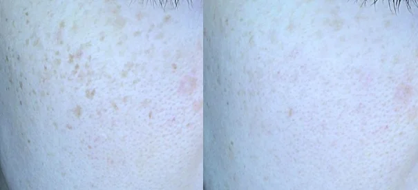 아리엘의원 맞춤레이저 시술 전후 비교