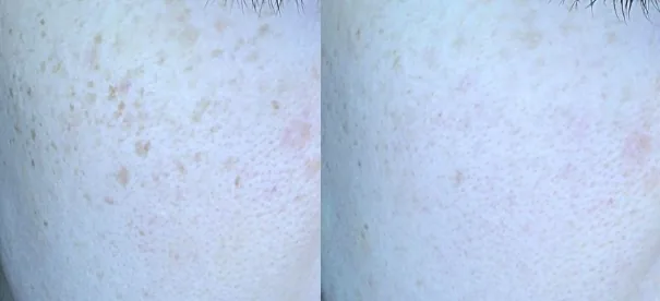아리엘의원 맞춤 레이저 색소 치료 전후 비교 사진 2