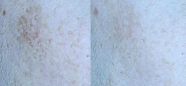 아리엘의원 맞춤 레이저 흑자 치료 전후 비교 사진 1