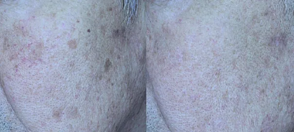아리엘의원 맞춤 레이저 흑자 치료 전후 비교 사진 2