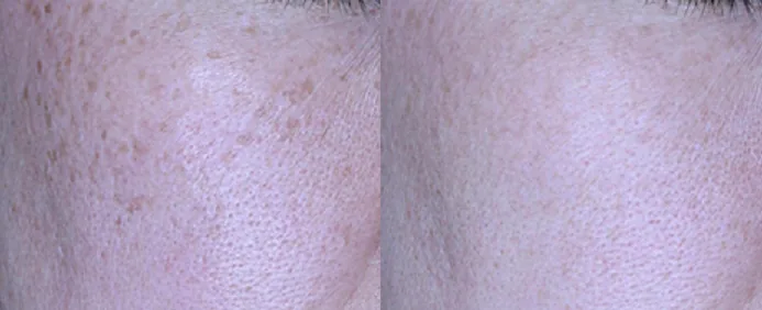 아리엘의원 맞춤 레이저 기미 치료 전후 비교 사진 1