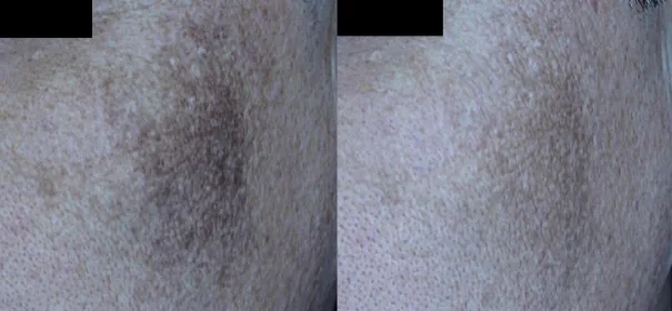 아리엘의원 맞춤 레이저 기미 치료 전후 비교 사진 2