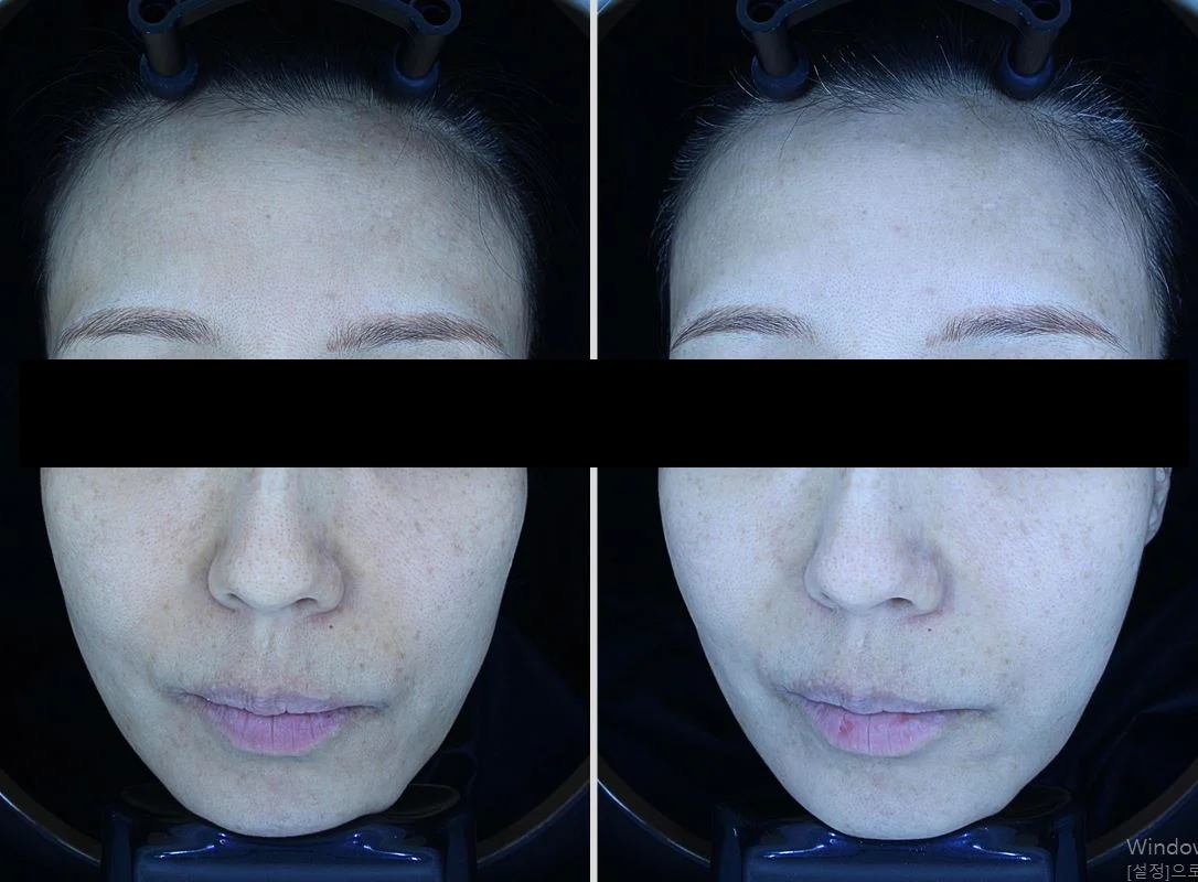 아리엘의원 포텐자+쥬베룩+맞춤레이저 시술 전후 비교