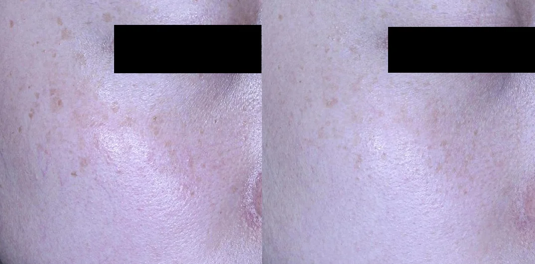 아리엘의원 포텐자+쥬베룩+맞춤레이저 시술 전후 비교