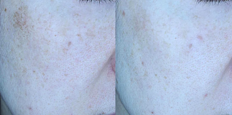 아리엘의원 포텐자+쥬베룩+맞춤레이저 시술 전후 비교