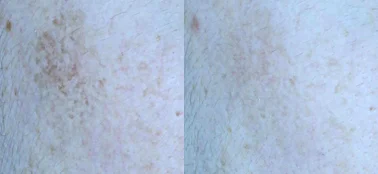 아리엘의원 포텐자+쥬베룩+맞춤 레이저 흑자 치료 시술 전후 비교 사진 (시술 2024-06-29 → 촬영 2024-08-31, 시술 후 약 2개월)