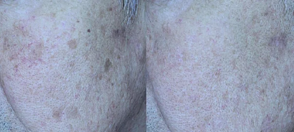 아리엘의원 포텐자+쥬베룩+맞춤레이저 시술 전후 비교