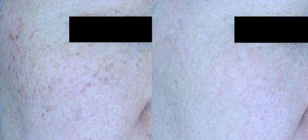 아리엘의원 포텐자+쥬베룩+맞춤레이저 기미 시술 전후 비교