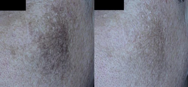 아리엘의원 포텐자+쥬베룩+맞춤레이저 기미 시술 전후 비교