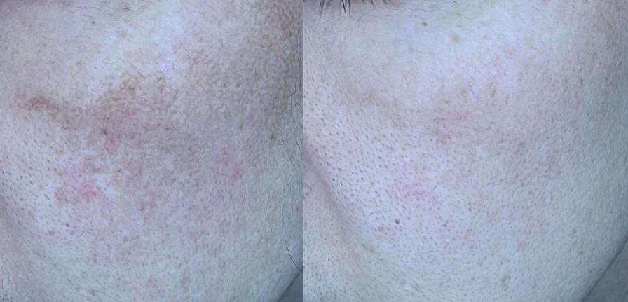 아리엘의원 포텐자+쥬베룩+레이저 시술 전후 비교