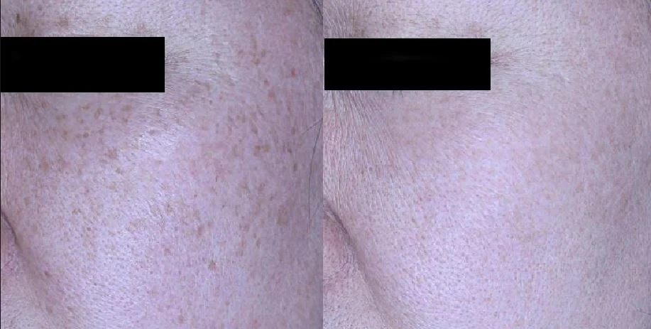 아리엘의원 포텐자+쥬베룩+레이저 시술 전후 비교