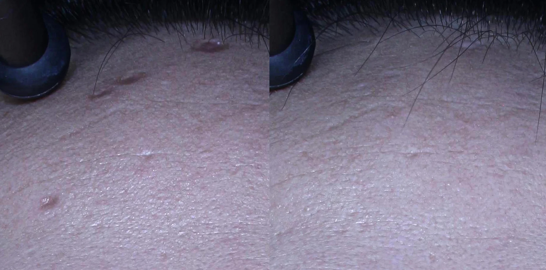 아리엘의원 큐어젯 시술 전후 비교