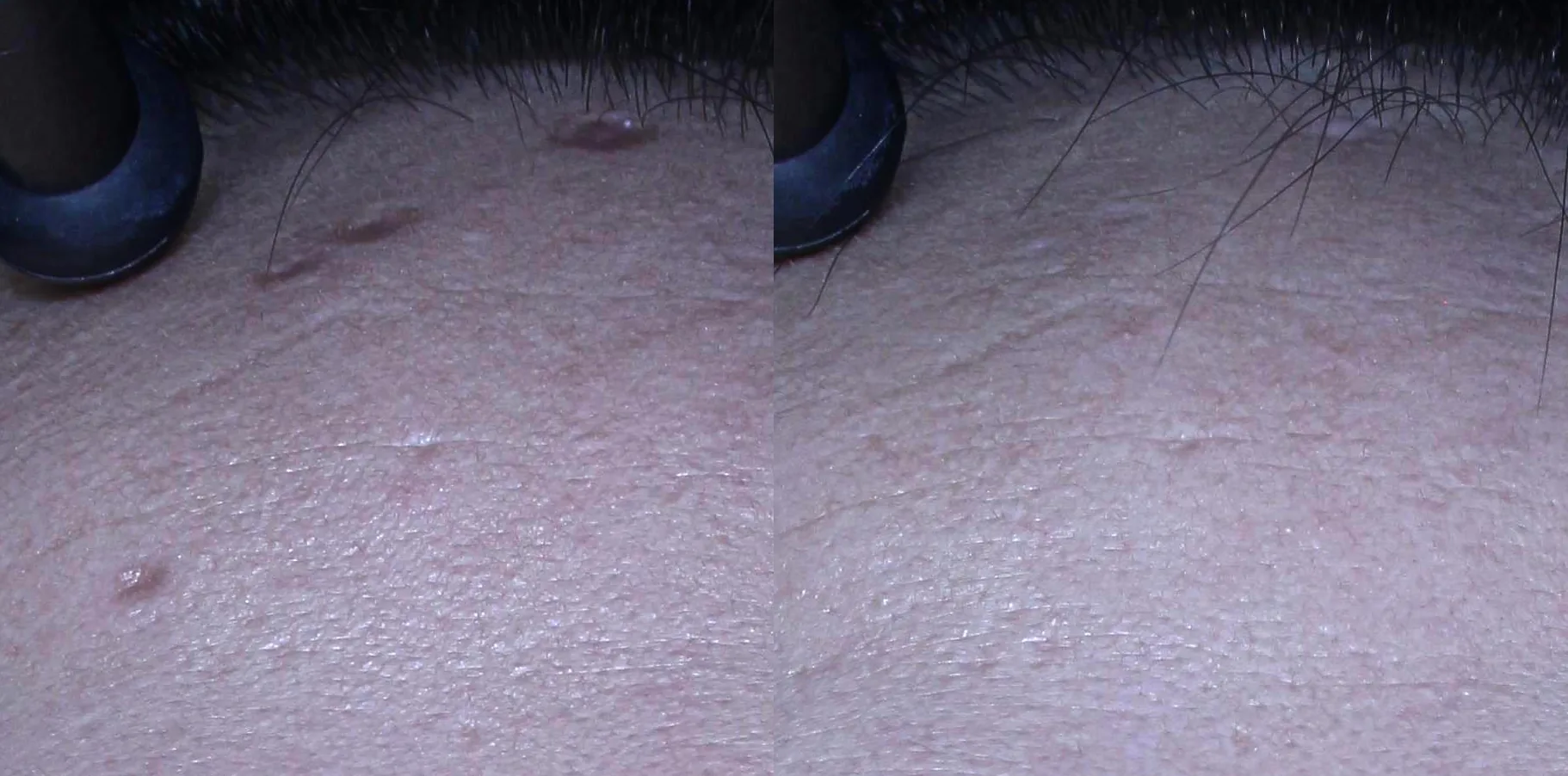 아리엘의원 큐어젯 모공 치료 전후 비교 사진 1