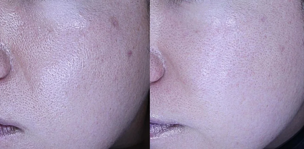 아리엘의원 포텐자+엑소좀+레이저 시술 전후 비교