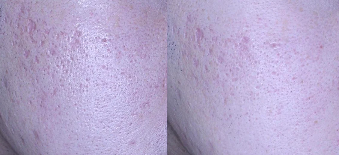 아리엘의원 포텐자+엑소좀+레이저+손주사 시술 전후 비교