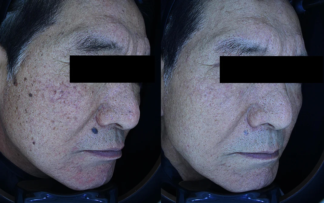 아리엘의원 포텐자+쥬베룩+레이저+큐어젯 시술 전후 비교