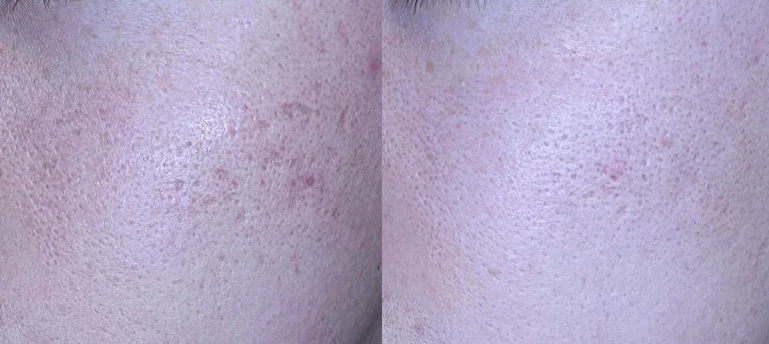 아리엘의원 포텐자+쥬베룩+레이저+큐어젯 시술 전후 비교