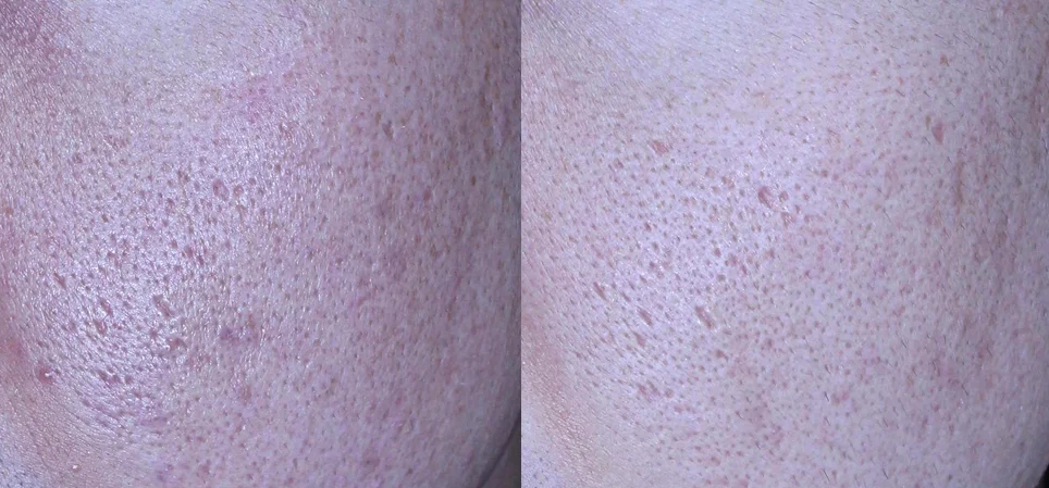 아리엘의원 포텐자+쥬베룩+레이저+큐어젯 시술 전후 비교