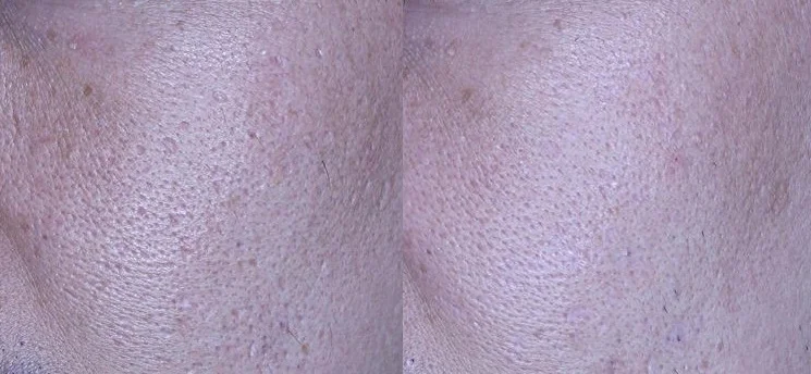 아리엘의원 포텐자+쥬베룩+레이저+큐어젯 시술 전후 비교