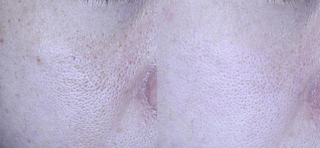 아리엘의원 쥬베룩 스킨부스터 전후 비교 사진 1