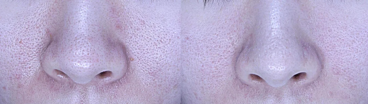 아리엘의원 쥬베룩 스킨부스터 전후 비교 사진 2