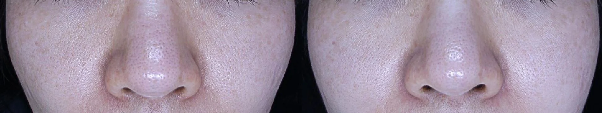 아리엘의원 리쥬란 시술 전후 비교