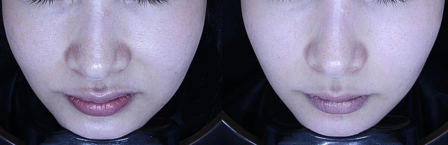 아리엘의원 줄기세포 시술 전후 비교