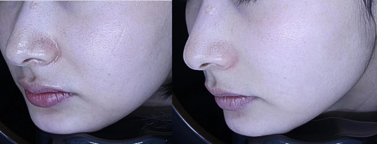 아리엘의원 줄기세포 시술 전후 비교