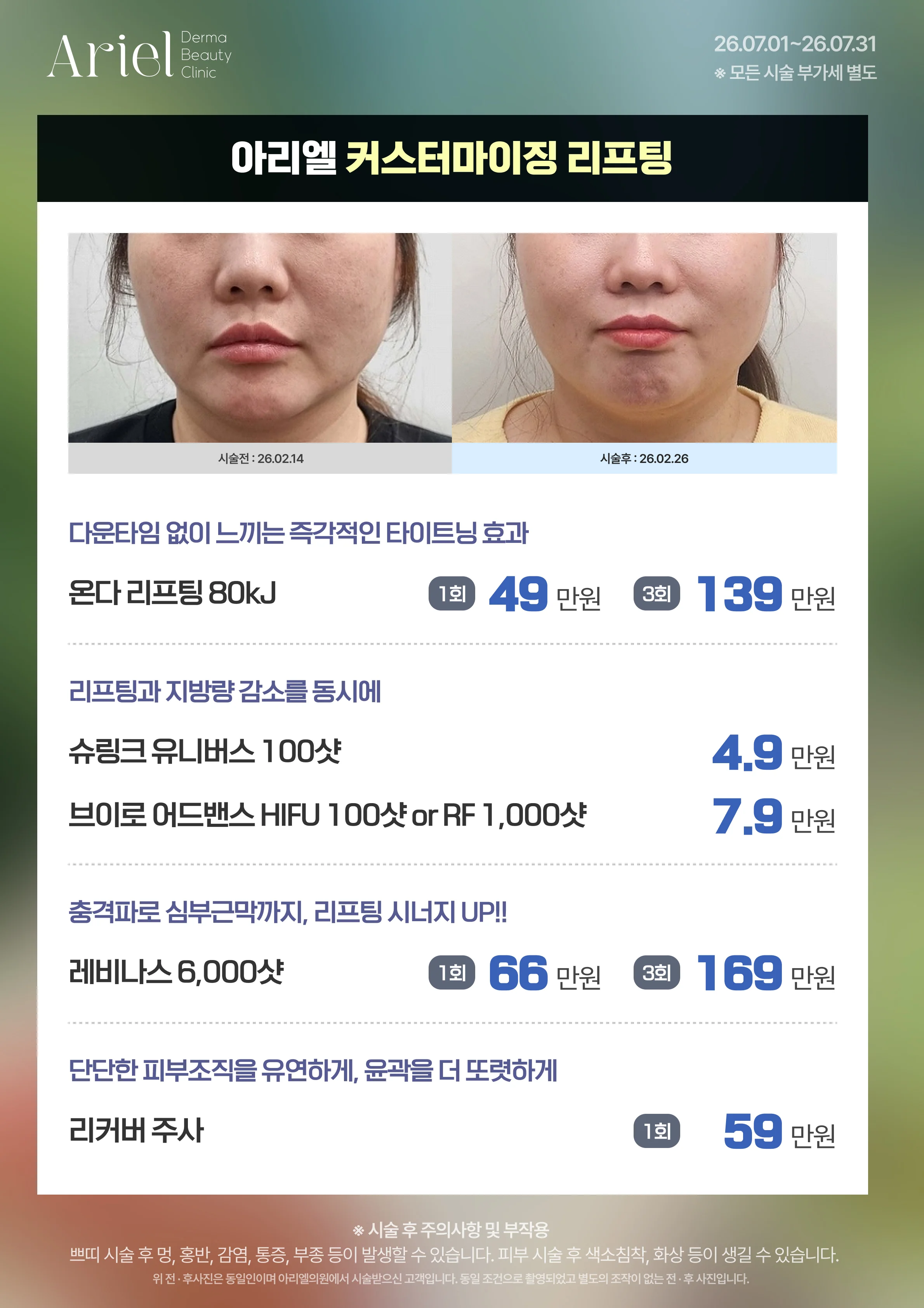 7월 이벤트 — 아리엘 커스터마이징 리프팅 (온다 80kJ 49만원, 슈링크 유니버스 100샷 4.9만원, 브이로 어드밴스 7.9만원, 레비나스 6,000샷 66만원, 리커버 주사 59만원)