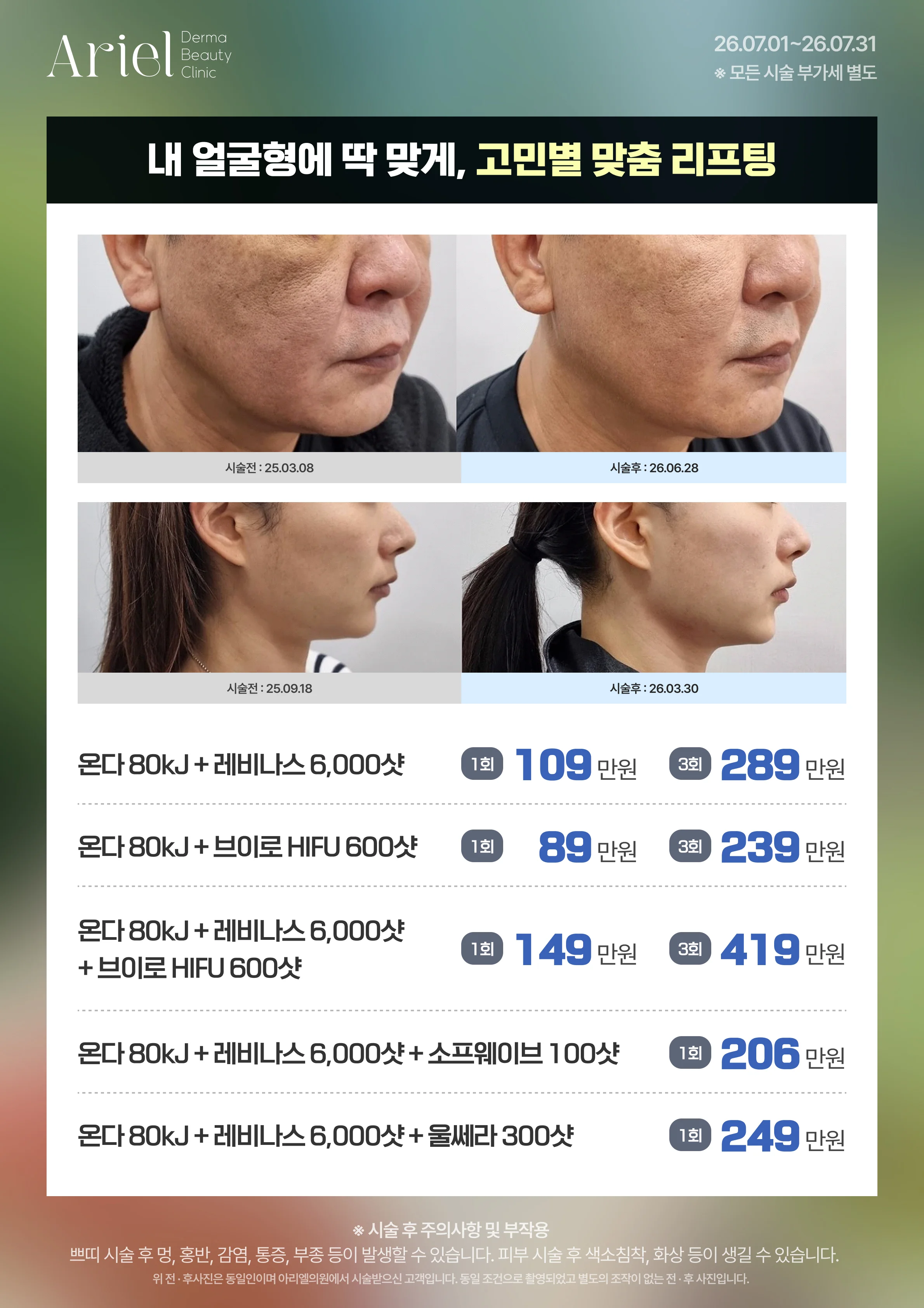 7월 이벤트 — 내 얼굴형에 딱 맞게 고민별 맞춤 리프팅 (온다+레비나스 109만원, 온다+브이로 HIFU 89만원, 온다+레비나스+브이로 149만원, +소프웨이브 206만원, +울쎄라 249만원)