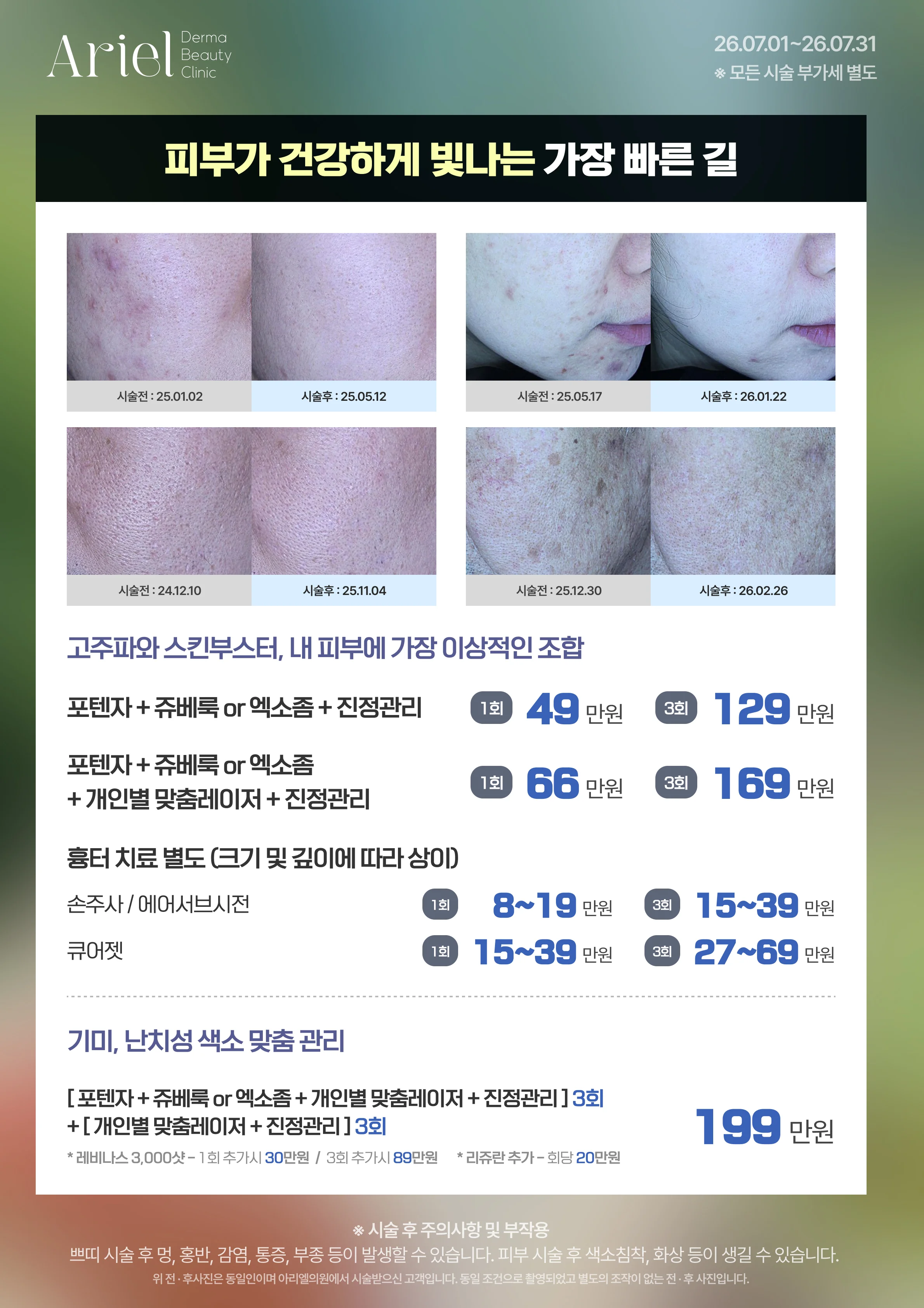 7월 이벤트 — 피부가 건강하게 빛나는 가장 빠른 길 (포텐자+쥬베룩 1회 49만원, 흉터 치료 손주사/에어서브/큐어젯, 기미·난치성 색소 맞춤 관리 199만원)