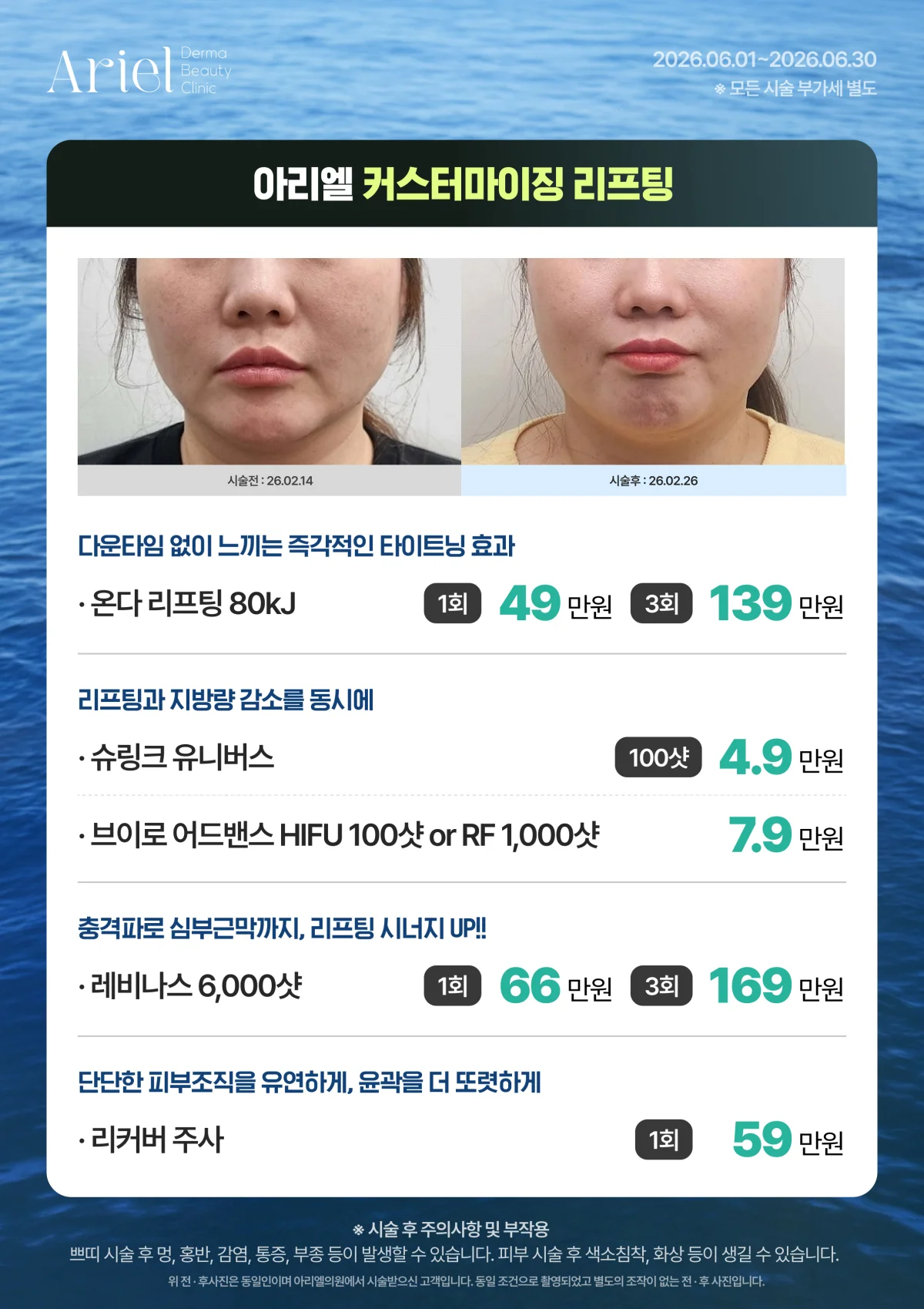 6월 이벤트 — 아리엘 커스터마이징 리프팅 (온다 80kJ·슈링크 유니버스·브이로 HIFU·레비나스·리커버 주사)