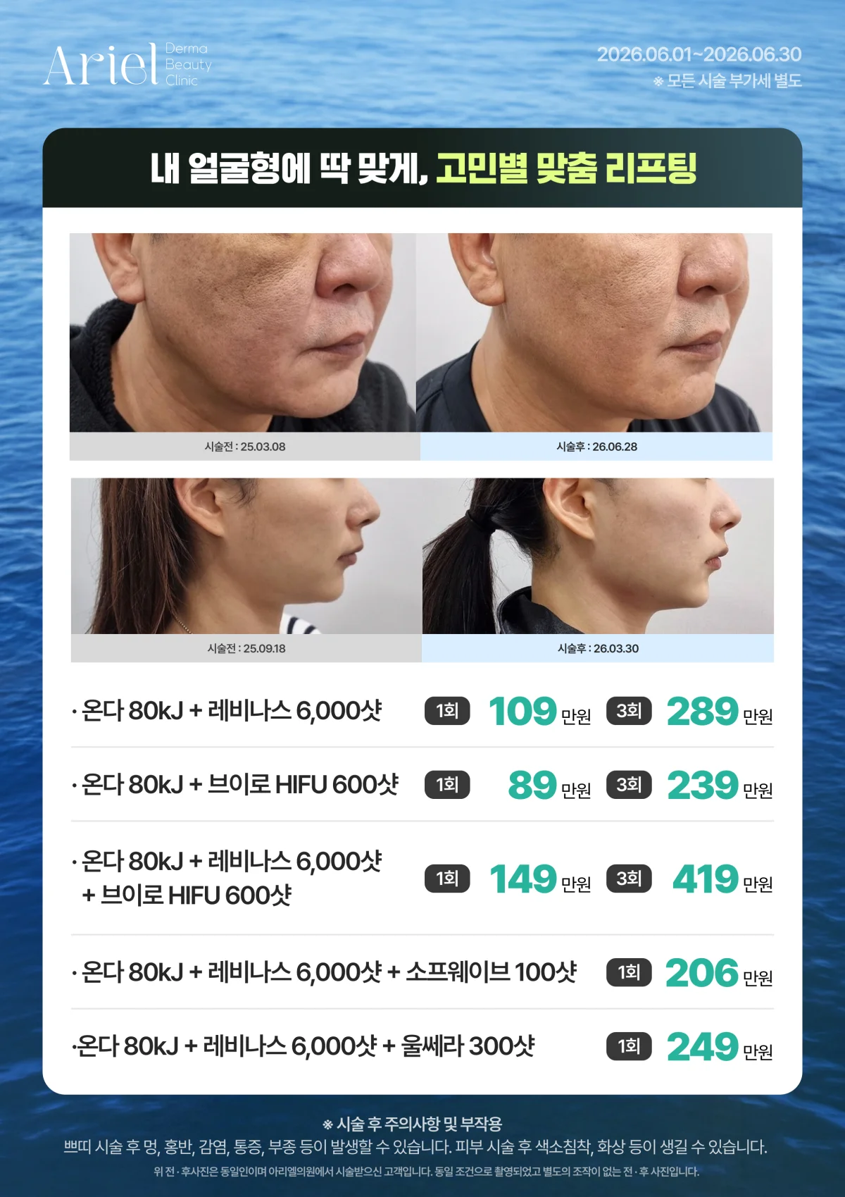 6월 이벤트 — 고민별 맞춤 리프팅 (온다·레비나스·브이로 HIFU·소프웨이브·울쎄라 조합)