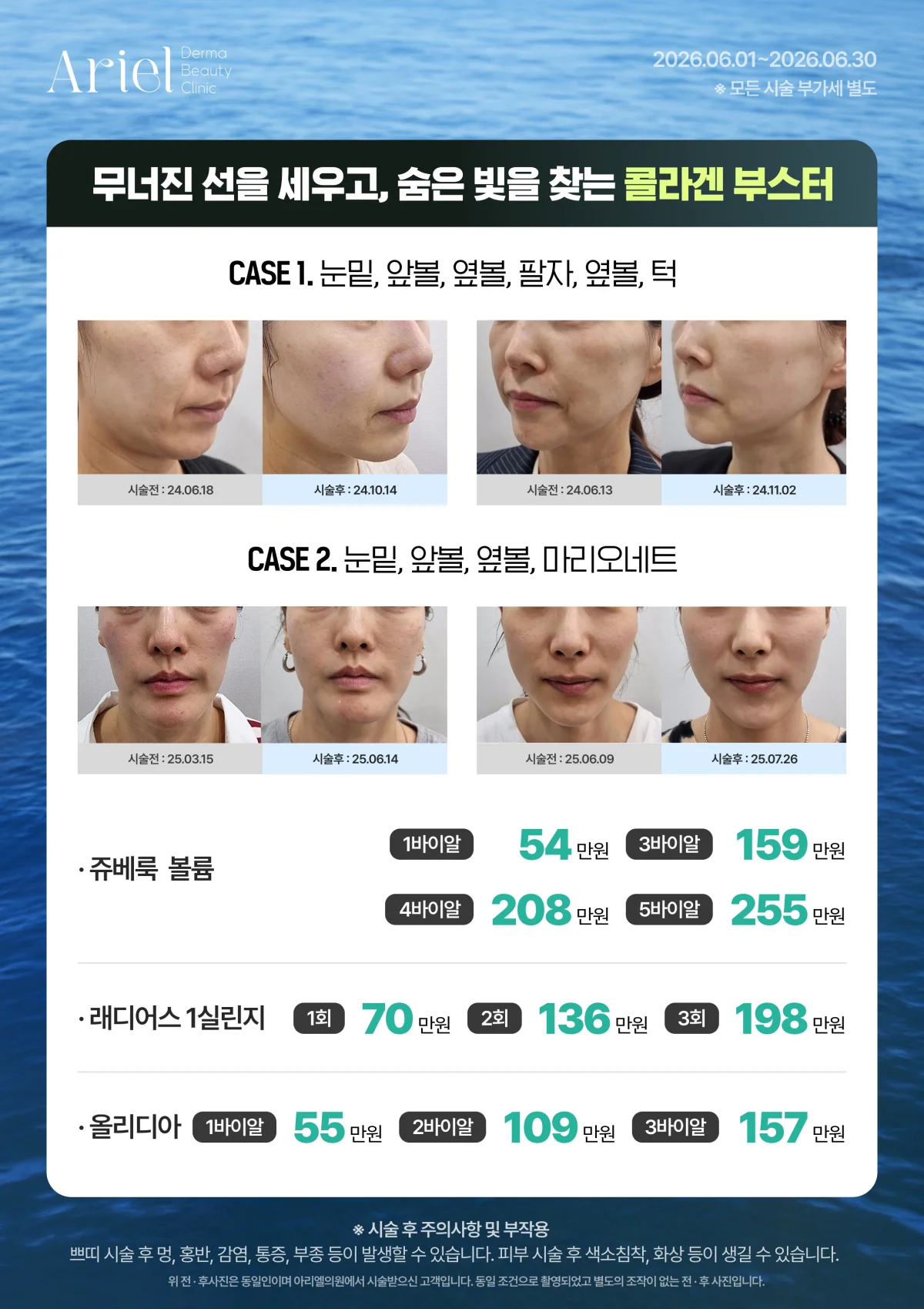 6월 이벤트 — 콜라겐 부스터 (쥬베룩 볼륨·래디어스·올리디아)