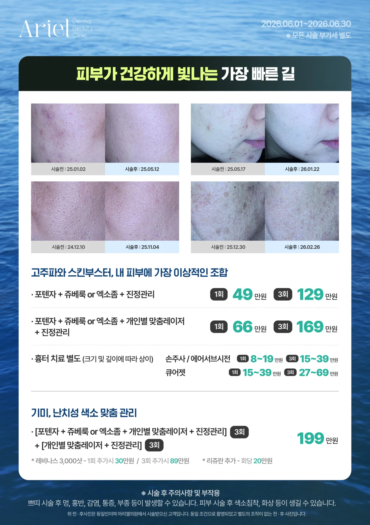 6월 이벤트 — 기미·난치성 색소 맞춤 관리 (포텐자+쥬베룩+개인별 맞춤 레이저+진정관리)