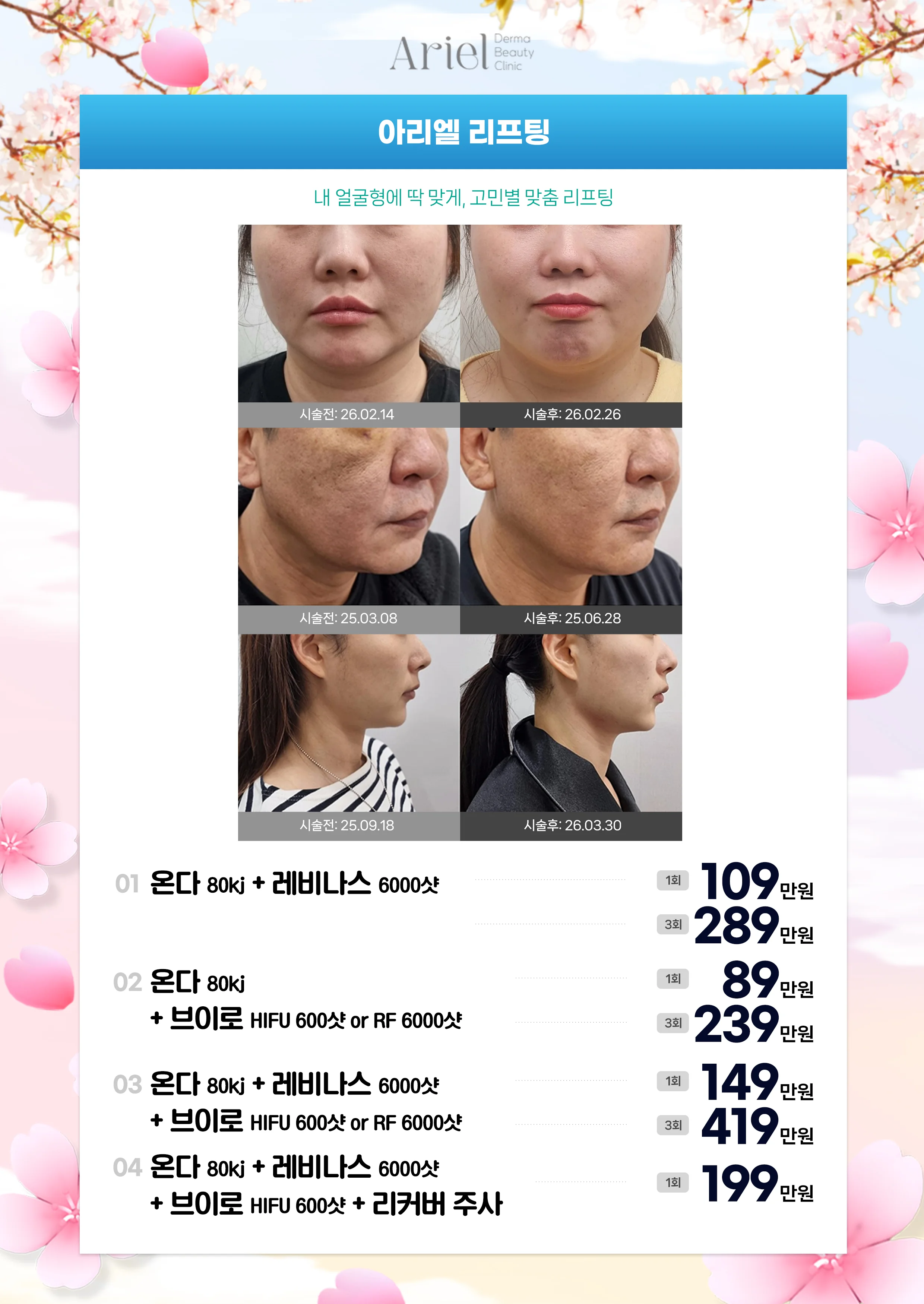 5월 이벤트 — 아리엘 리프팅 4종 패키지