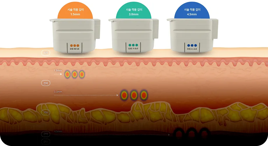 초음파 리프팅